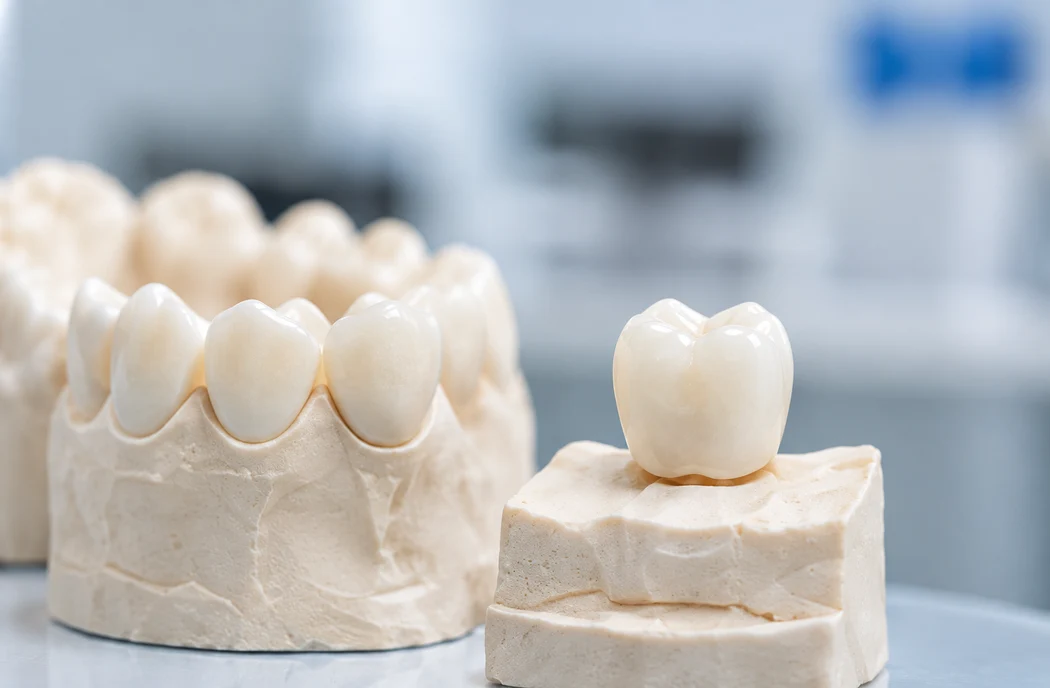 Illustrative dental model and porcelain crown